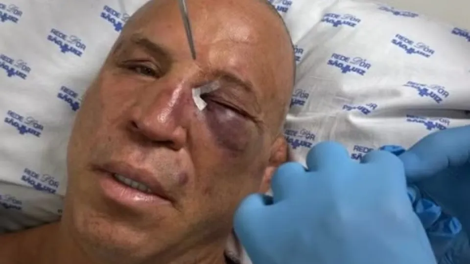 Com olho roxo, Wanderlei recebe alta após nocaute em pancadaria