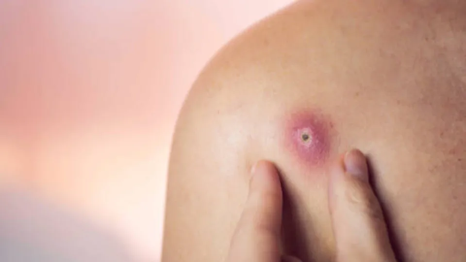 Furúnculo pode matar? Dermatologista alerta sobre riscos