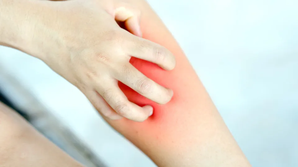 Coceira persistente nas pernas pode indicar problemas nas veias